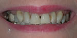 before veneers in Merritt Island FL