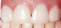 Veneers