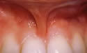 before Frenectomy