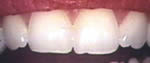 before Enamel Shaping