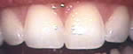 after Enamel Shaping